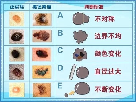 頭頂有黑痣|是痣還是瘤？黑色素瘤的類型、症狀與治療